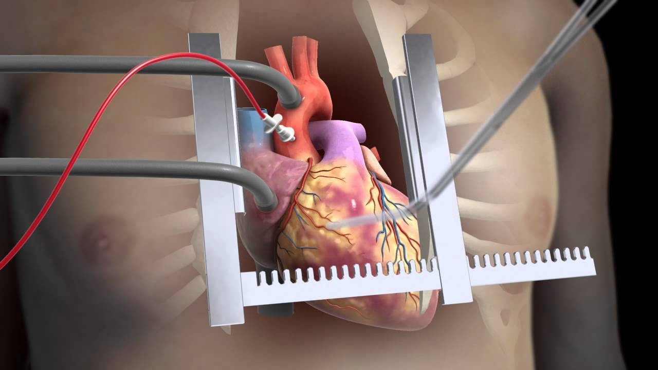 عملية قلب مفتوح كاملة - من اخطر العمليات 2696 4