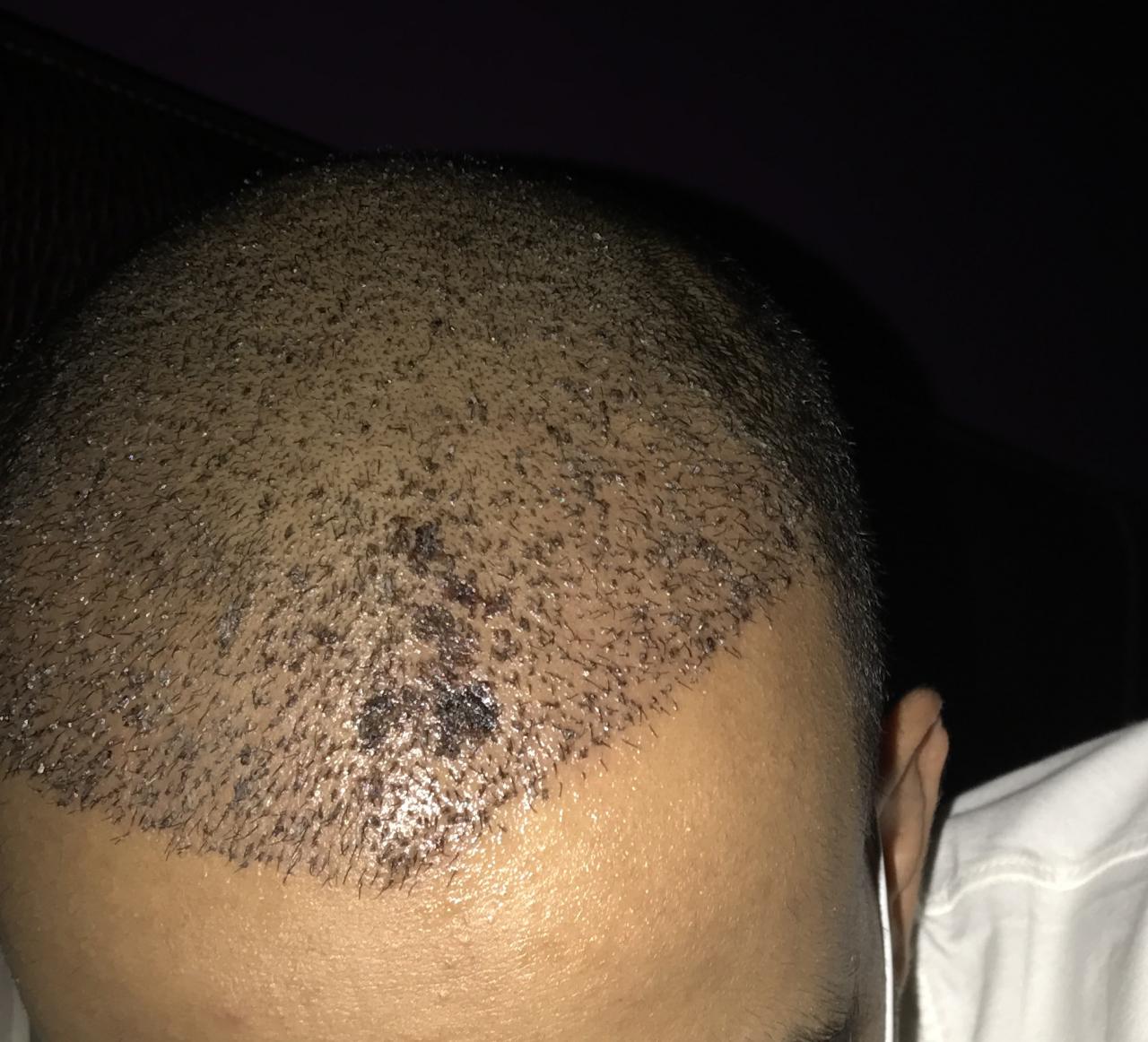 بعد زراعة الشعر باسبوع - بعض الاشخاص تصاب بها 3978 3