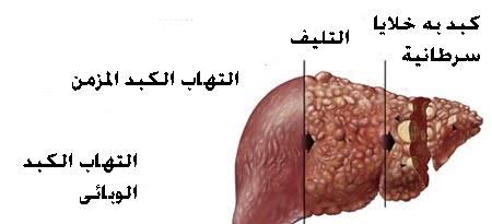 اعراض فيروس الكبد C - تعرفي علي مرض فيروس سي