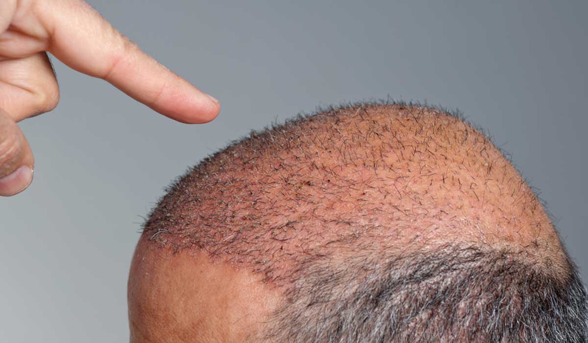 بعد زراعة الشعر باسبوع - بعض الاشخاص تصاب بها 3978 2