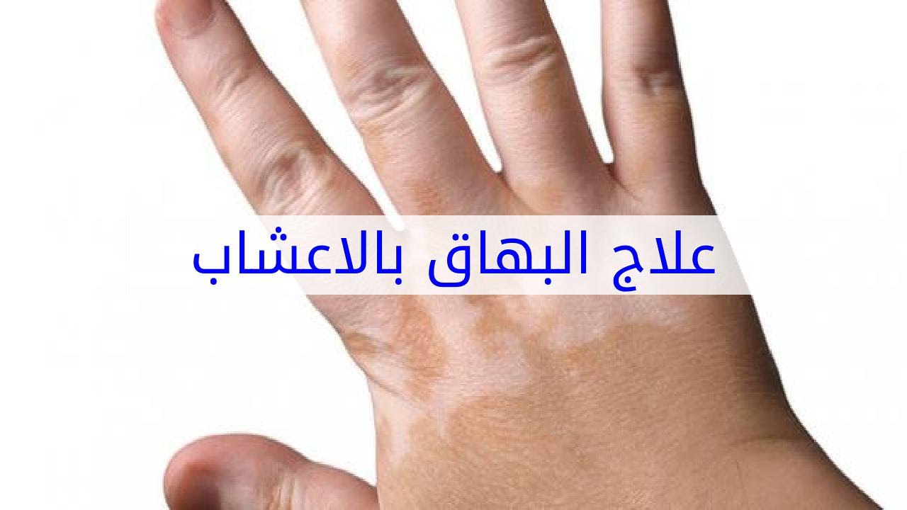 علاج البرص بالاعشاب - نجده ولا نجد له علاج يفيد حلك عندي 3009