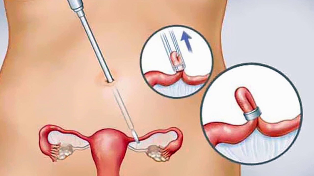 عملية ربط الرحم , هيا اوجع العمليات
