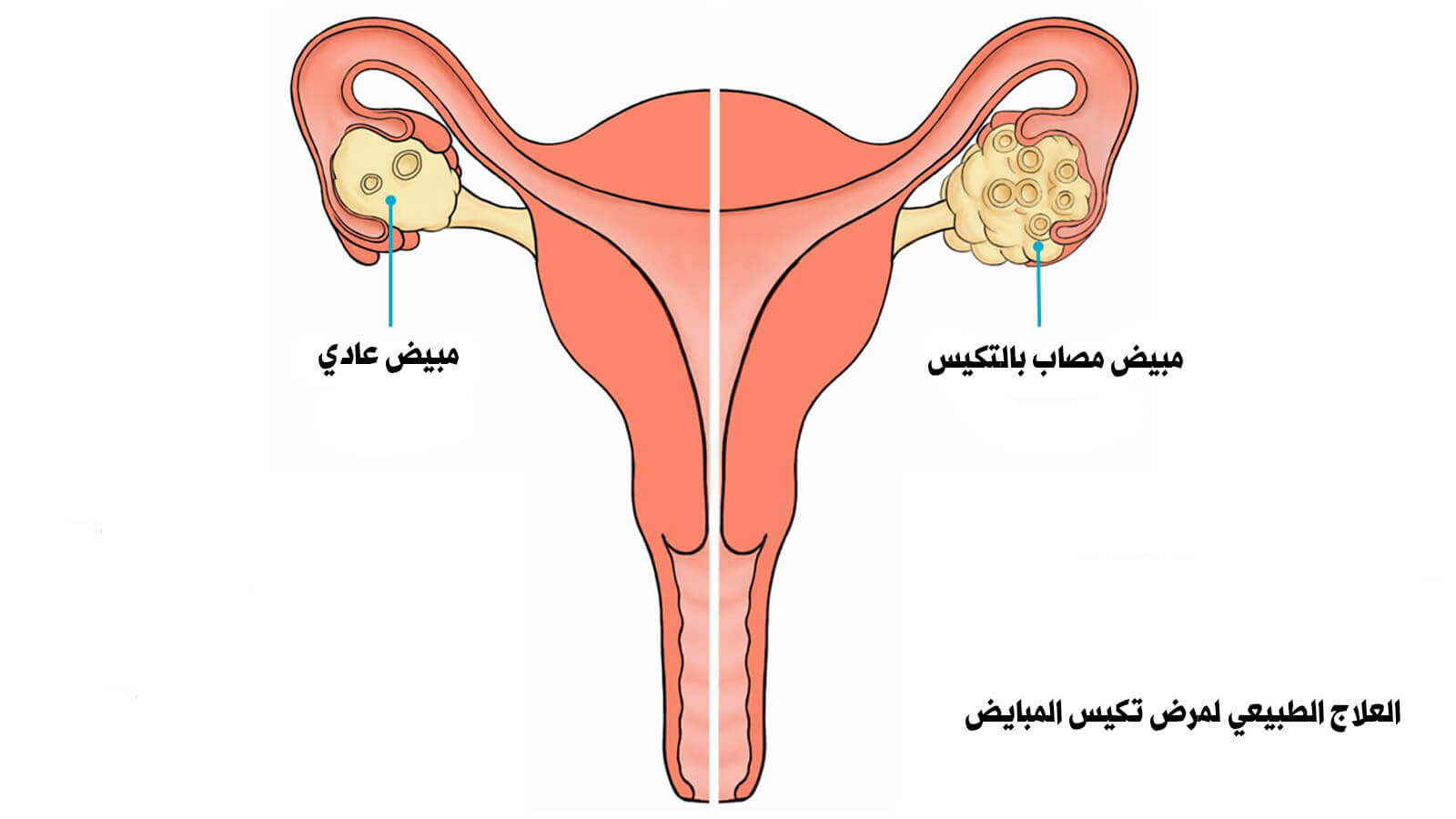 اعراض زيادة هرمون الحليب , يحدث لبعض السيدات