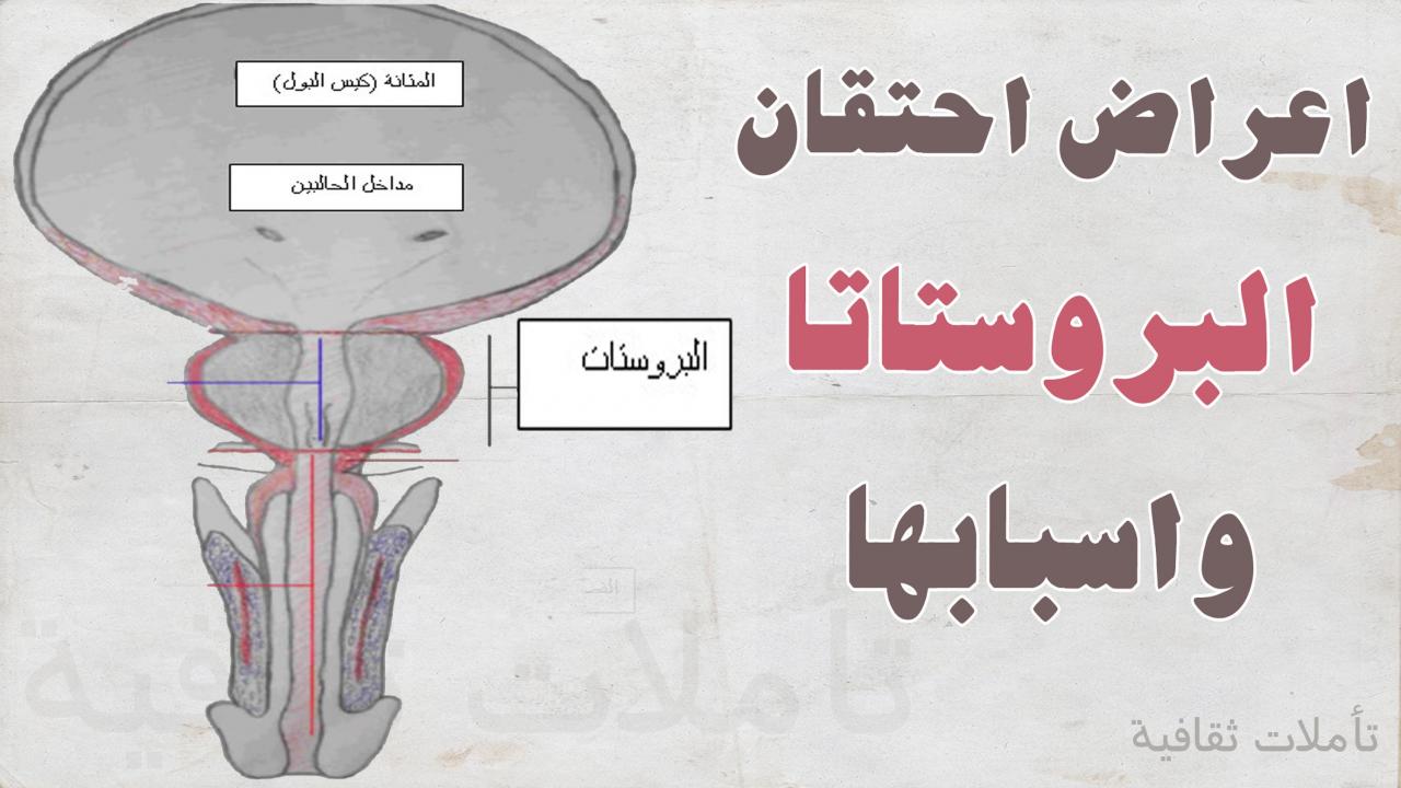 اعراض تضخم البروستاتا عند الشباب - العلاقة بين البروستاتا واحتباس البول فى المثانة 1177 3