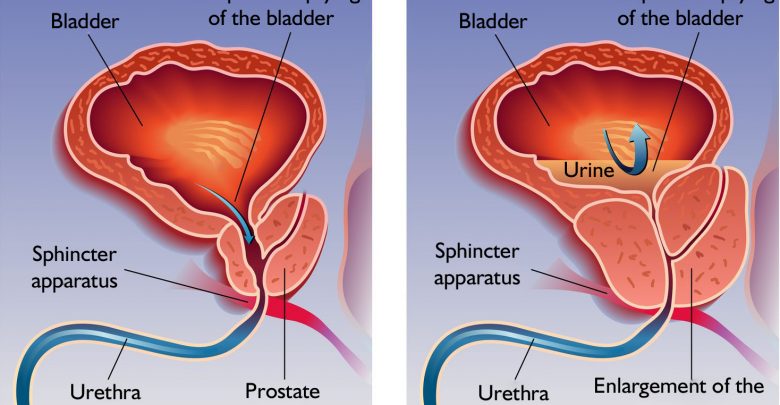 الفرق بين سرطان البروستاتا وتضخم البروستاتا , معلومات عن مرض السرطان