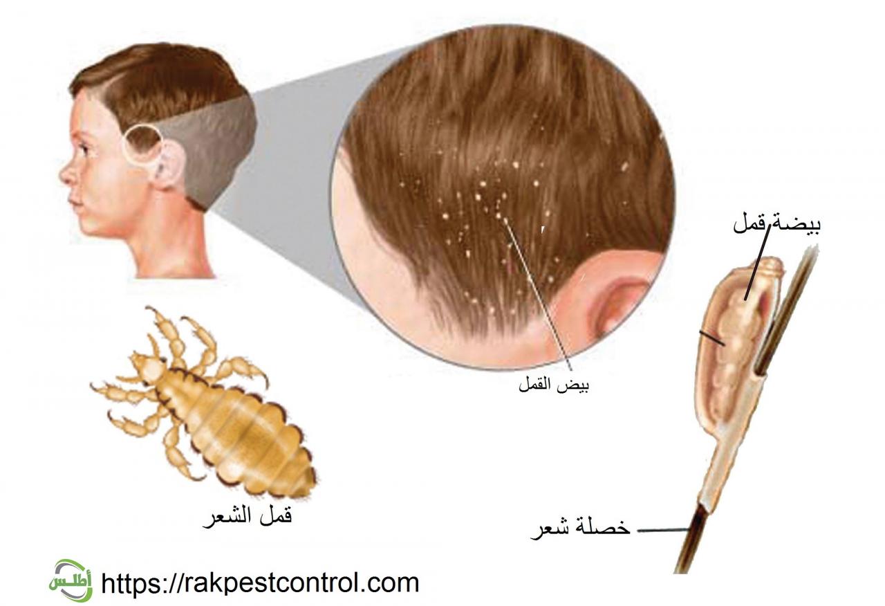 ما علاج القمل - للقضاء علي القمل فورا 1423 2