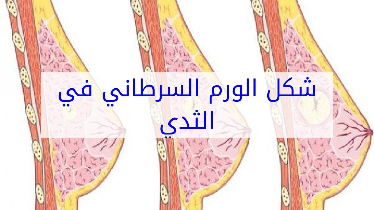 ورم في الصدر , هو يحدث لكثير من السيدات