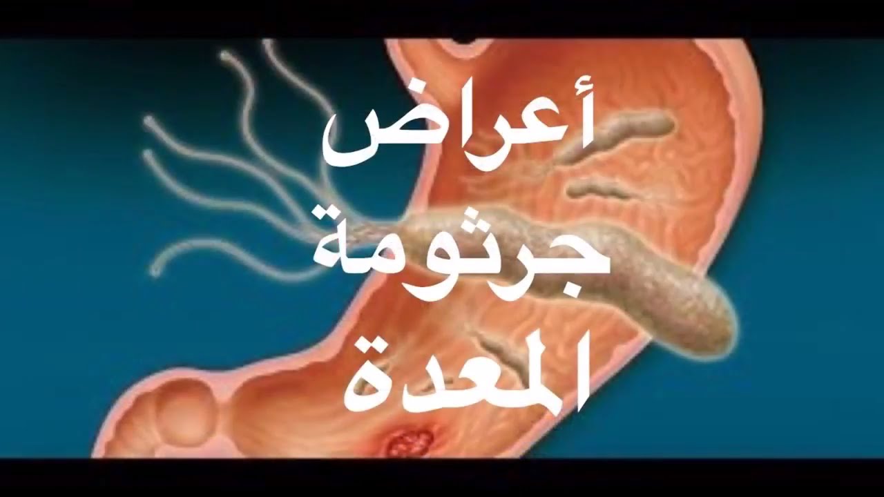 علامات جرثومة المعده - هل هذا شكلها 3073 3