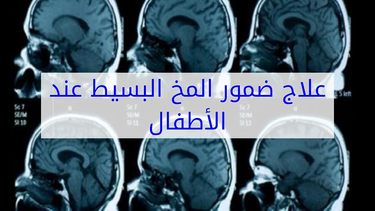 اسباب ضمور المخ - يحدث لبعض الاطفال 6347