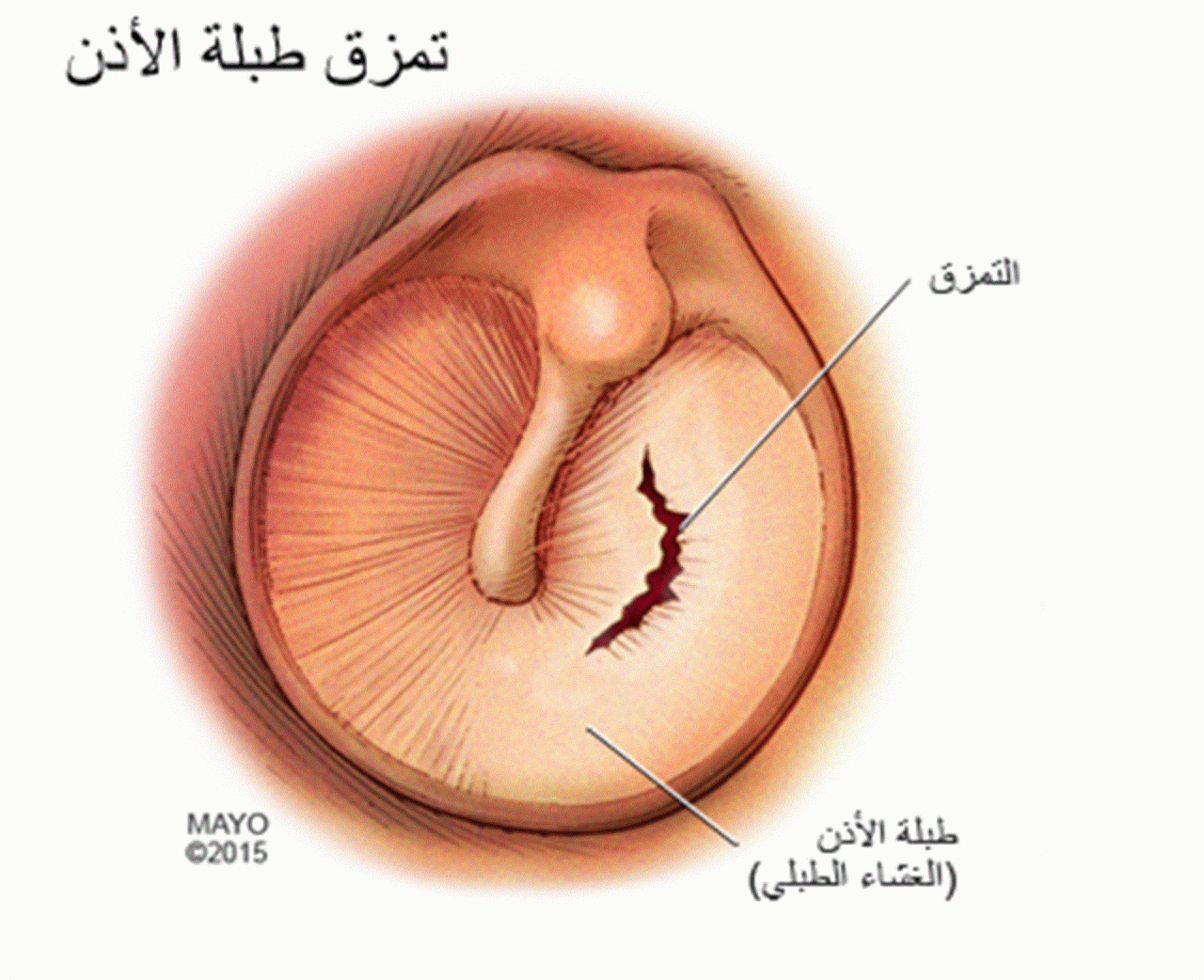 اعراض ثقب الاذن- ربما يكون هذا هو السبب وراء امراض الاذن 335