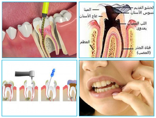 اعراض عصب الاسنان- اذا شعرت بهذه المشاكل فانت اكيد تعاني من عصب الاسنان 424 1