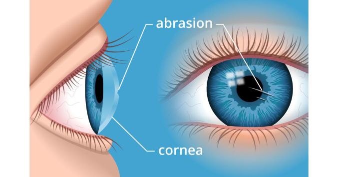 علاج خدش القرنية , اضرار العدسات اللاصقه