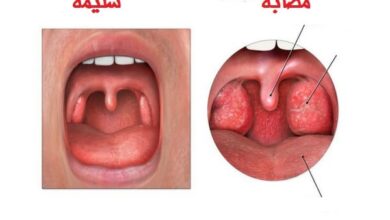 معلومات عن سرطان اللوزتين , كيفيه علاج سرطان اللوزتين