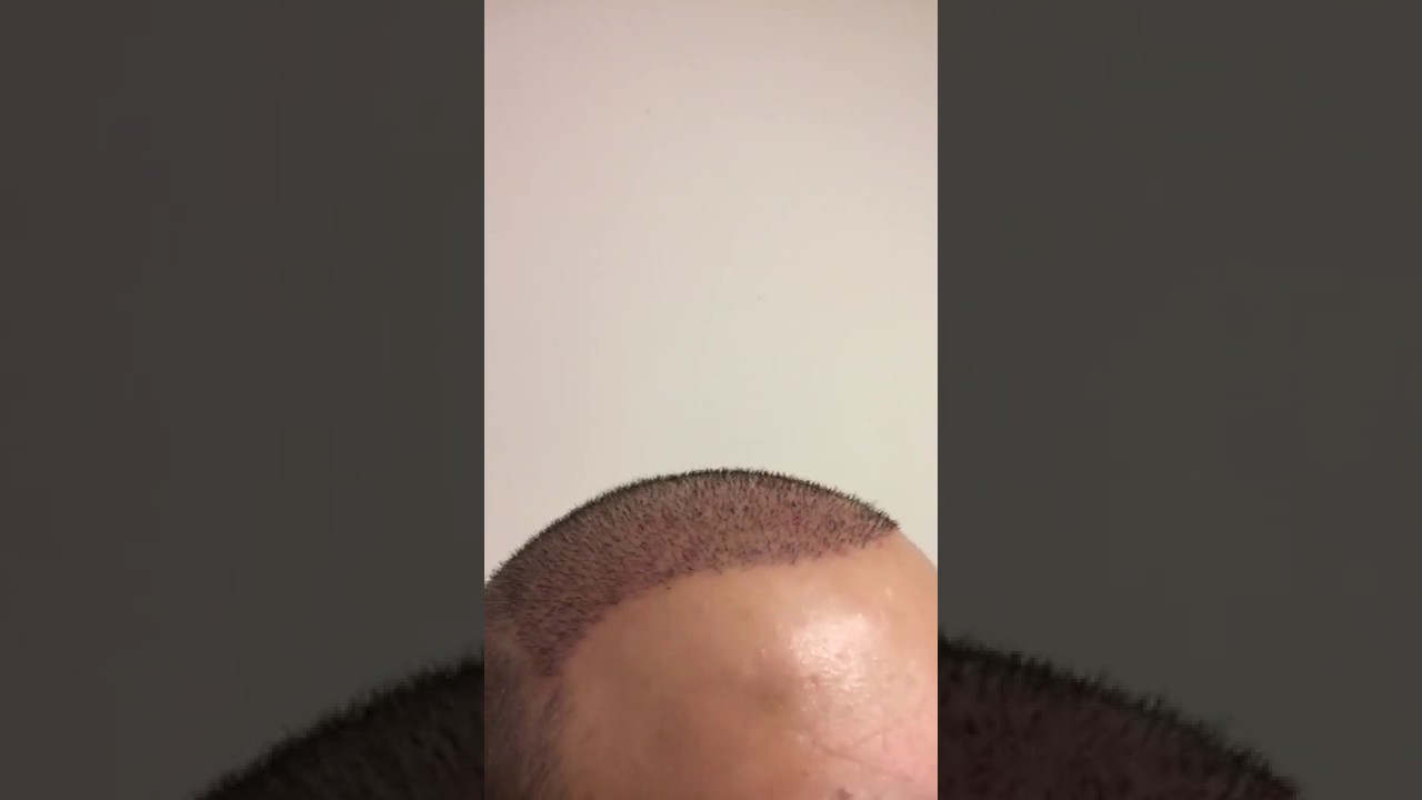 بعد زراعة الشعر باسبوع - بعض الاشخاص تصاب بها 3978 1