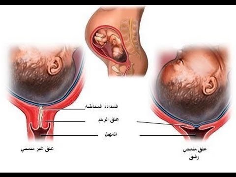 عنق الرحم مفتوح - عنق الرحم و ضعفه عند بعض النساء 2784 1