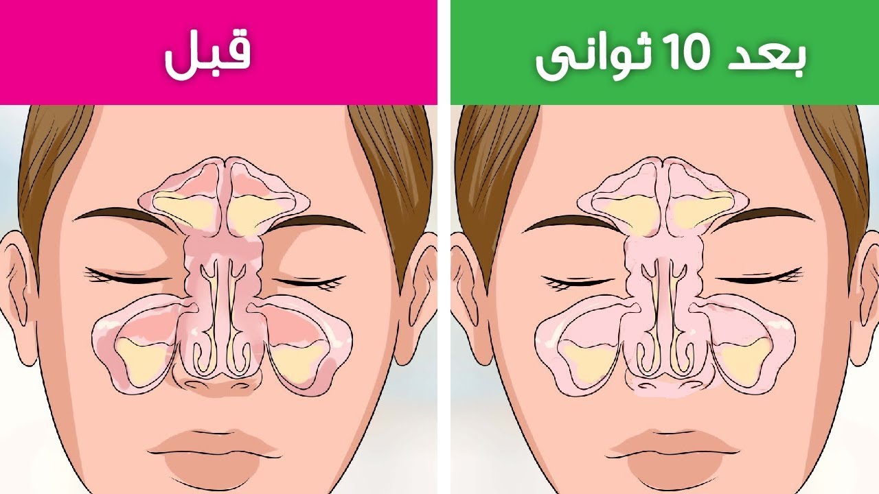 كيف اتخلص من حساسية الانف - توجد خاصة في الشتاء 2654 1