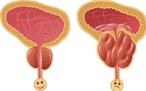 علاج تضخم البروستاتا - اسباب مرض البروستاتا وعلاجها السريع 3297