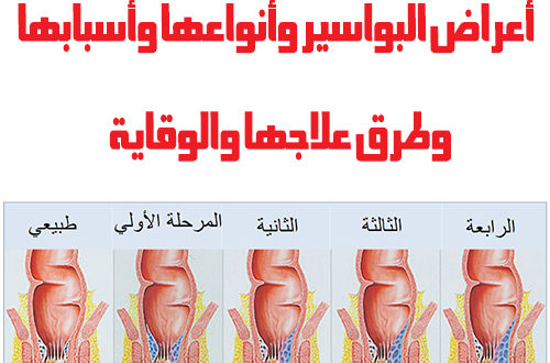 دواء لعلاج البواسير , وصفات طبيعية للتخلص من انتفاخ الاوعية الدموية