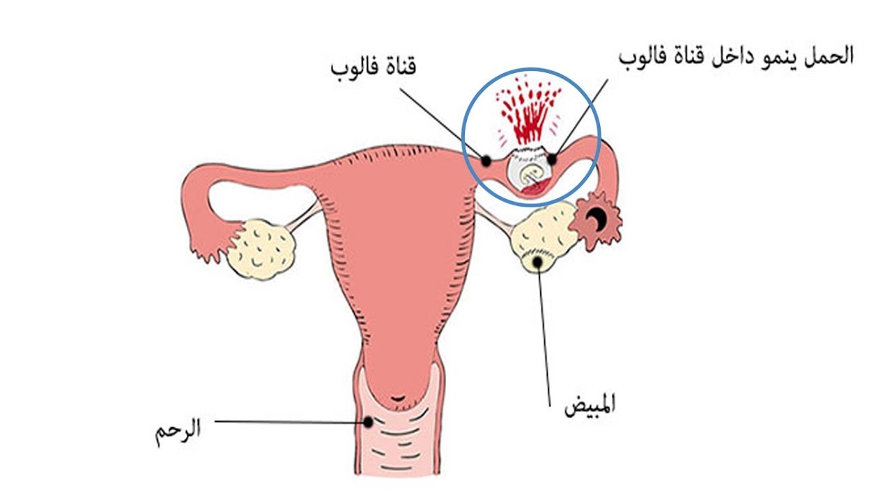 الحمل خارج الرحم بالصور - تعرفي على تفاصيل اكثر عن الحمل خارج الرحم 1699 1