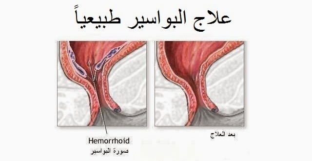 علاج طبيعي للبواسير - علاجك من منزلك 1339