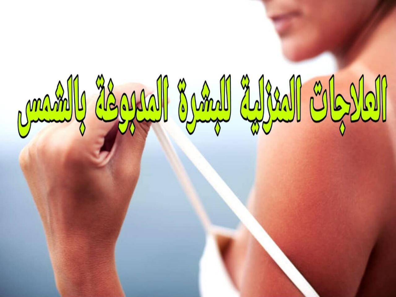 علاجات حروق الشمس المنزلية، اقوى علاج منزلي لحروق الشمس 10598 1