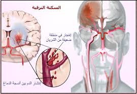 نصائح لمرضى الجلطة الدماغية , ارشادات لعلاج السكته الدماغيه