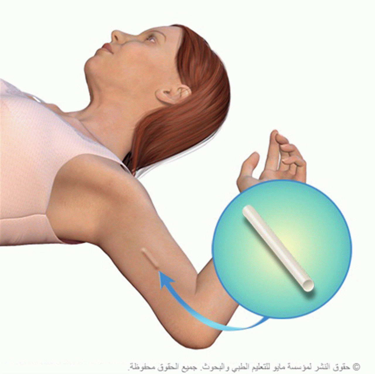 الغرزة لمنع الحمل - طرق لمنع الجمل 1213 1