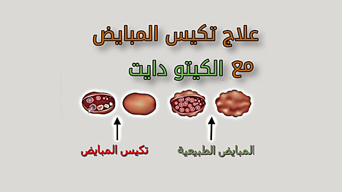 لعلاج تكيس المبايض سهل - تكيسات المبايض وحش يهدد امومتك 6236 1