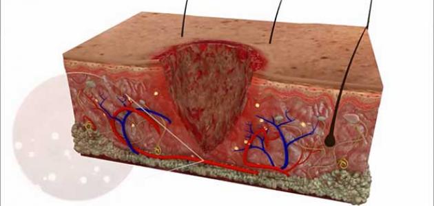 تنظيف الجرح من الصديد - كيفية علاج الجرح المفتوح 2241