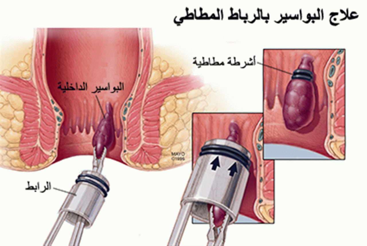 علاج البواسير التي تنزف دما - تخلص من الام البواسير للابد 1762