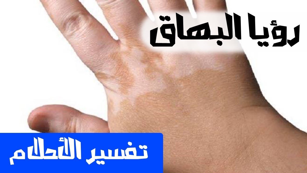 البهاق في المنام - راي المفسرين فى الحلم بالبهاق 3404 1