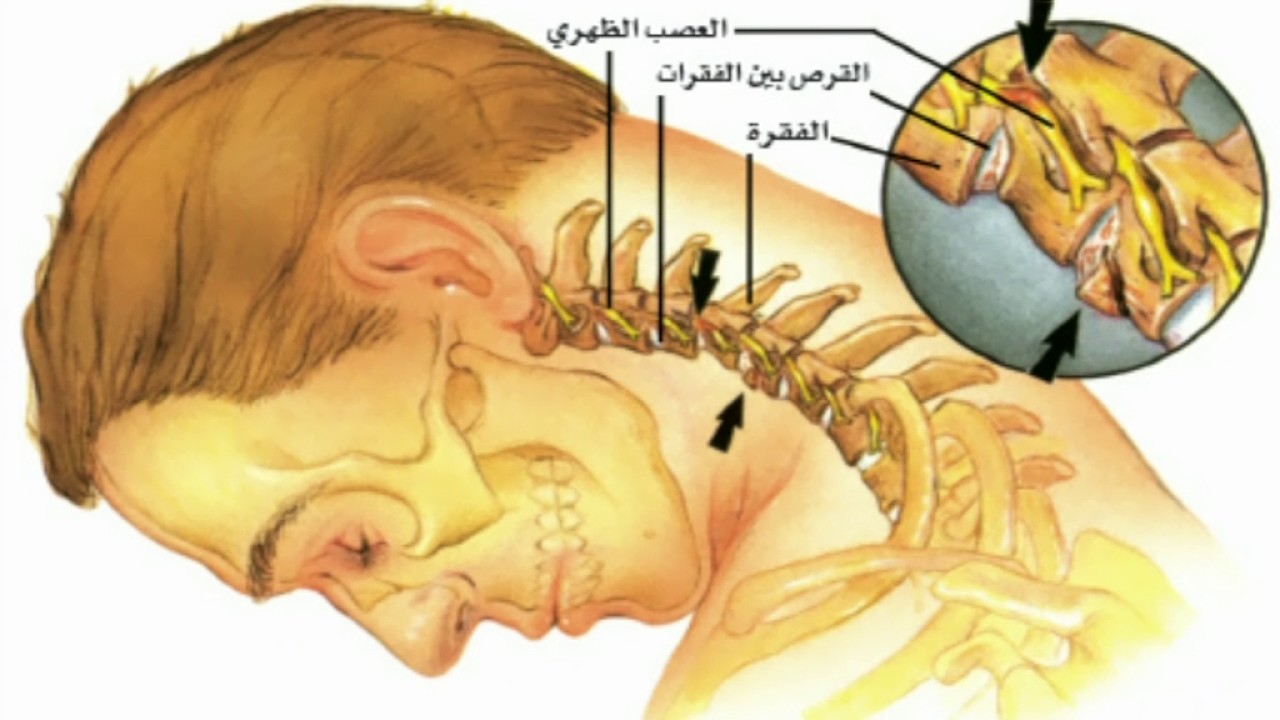 افضل علاج لالم الرقبة , طرق للتخفيف من الام الرقبة