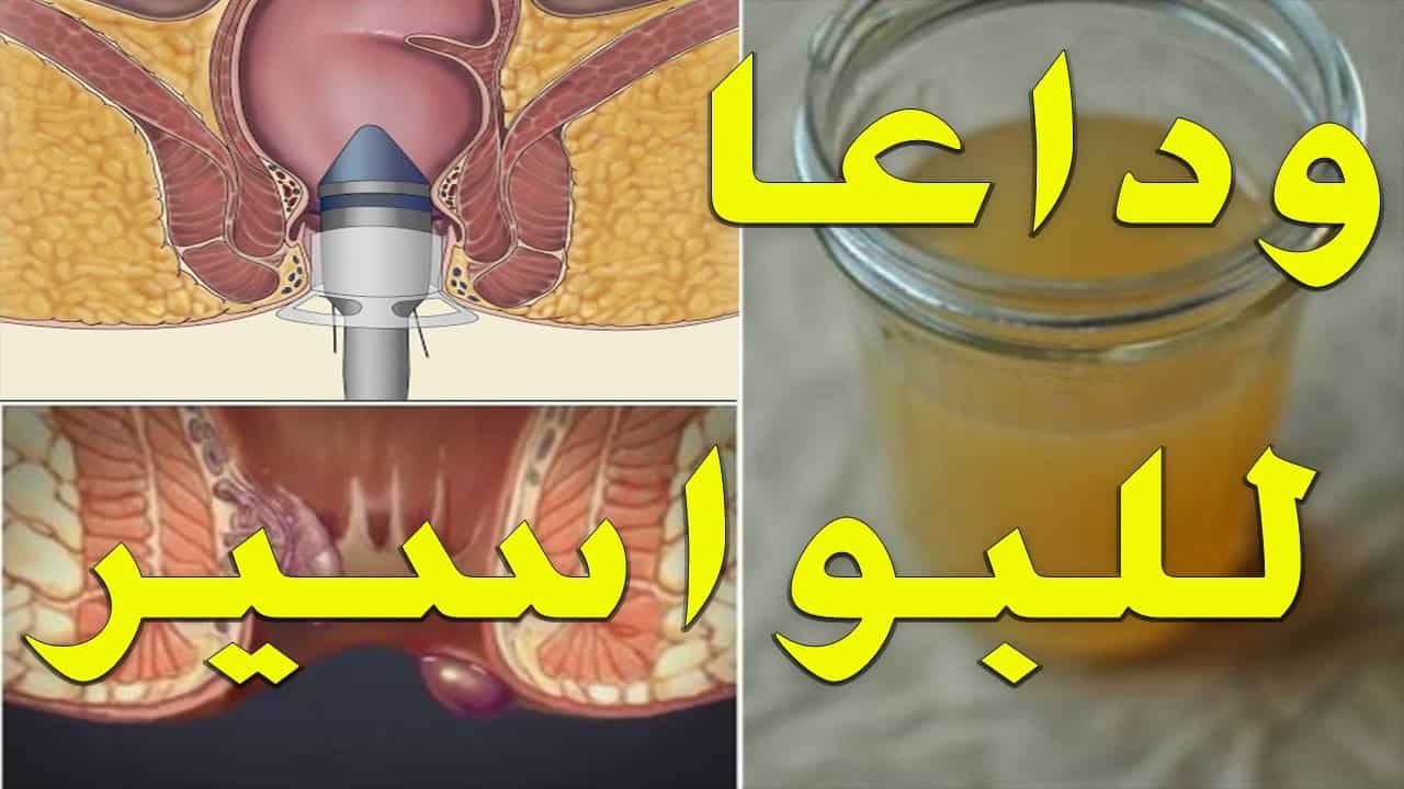 كريم للقضاء على البواسير , اكثر وجع في اوجع منطقة