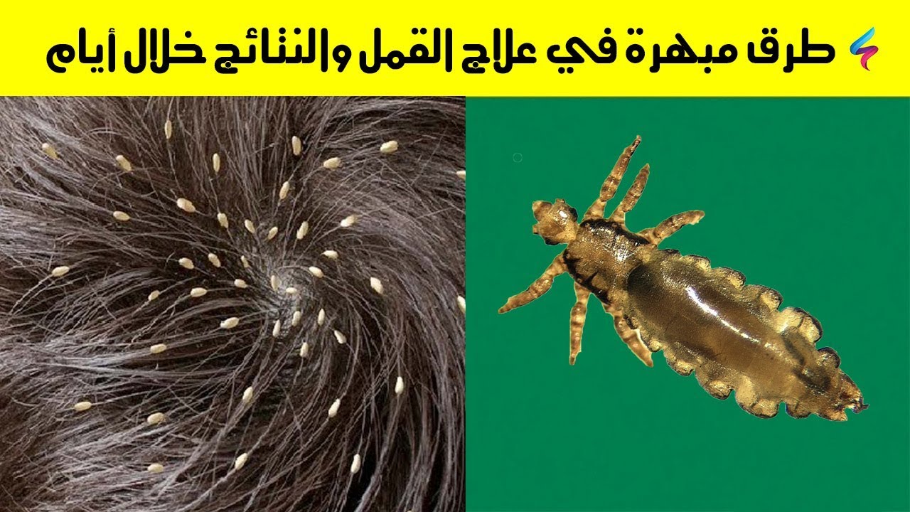 ما علاج القمل , للقضاء علي القمل فورا